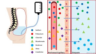 Peritoneal Dialysis [upl. by Vikky]