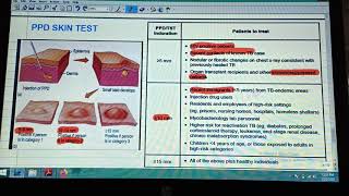 PPD SKIN test or Mantoux Test interpretation [upl. by Nnylidnarb334]