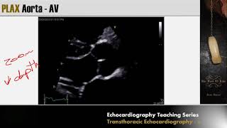 Echocardiography Essentials Mastering the apical fourchamber view 4CV [upl. by Crellen969]