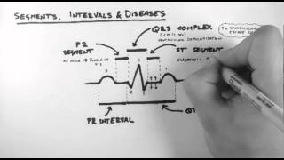 ECG 3  Segments Intervals amp Diseases [upl. by Amikan]