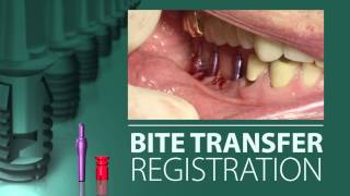 Implant Level Impression and Bite Registration [upl. by Sualocin200]