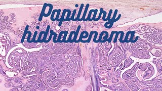 Papillary Hidradenoma [upl. by Llewoh67]