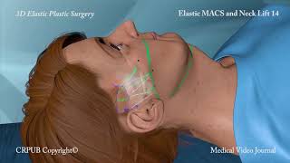 3D MACS and Neck Lift [upl. by Cook177]