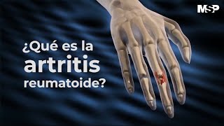 Artritis Reumatoide  ExclusivoMSP [upl. by Engud]