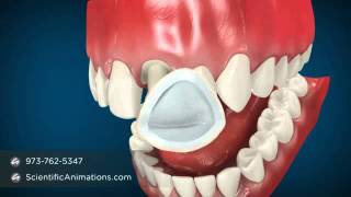 Dental Cap Procedure  Tooth Caps [upl. by Filipe143]