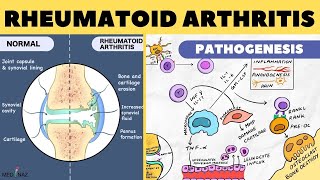 Rheumatoid Arthritis Pathophysiology  Rheumatoid Arthritis Pathogenesis  Arthritis pathophysiology [upl. by Guinna968]