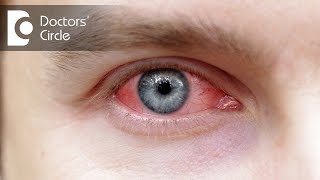 How to manage Eye Allergies  Dr Sriram Ramalingam [upl. by Geesey]