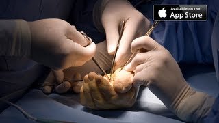 Carpal Tunnel Surgery [upl. by Ehcar261]