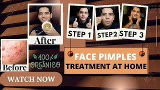 Face Pimples Treatment At Home  ACNE TREATMENT  Pimples Kese Hataye  shivammalik [upl. by Ause]