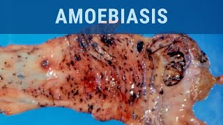 Amoebiasis  Pathology mini tutorial [upl. by Ethyl594]