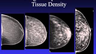 Introduction to Mammography [upl. by Cherlyn370]