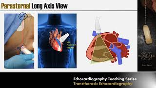 2D Vs 3D TTE for Tricuspid Valve Anatomy [upl. by Maloy]