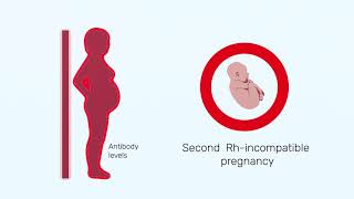 How Rh factor affects a pregnancy [upl. by Ettennal]