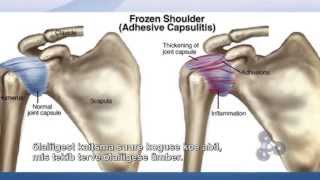 HOW TO FIX FROZEN SHOULDER TV SHOW ADHESIVE CAPSULITIS CURE TRIGENICS quotOATquot PROCEDURE [upl. by Hotze]