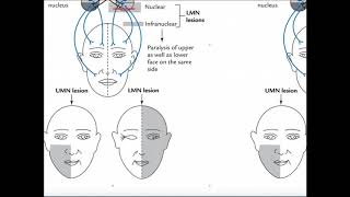 Meralgia Paresthetica Outer thigh numbness burning and tingling [upl. by Airamak]