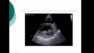 Lecture 3  Transthoracic Echocardiography Part 2 [upl. by Olnee]