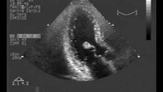 Thyroid neoplasms part 1  Papillary carcinoma of thyroid   Endocrine pathology [upl. by Ecined]