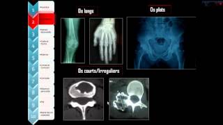 Approche diagnostique radiographique des tumeurs osseuses [upl. by Langan]