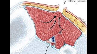 Compartment Syndrome [upl. by Saddler750]