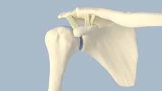 Acromioclavicular Separation Surgery [upl. by Gahan970]