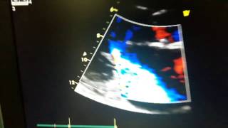 Calculation of PISA for Mitral regurgitation [upl. by Schach]