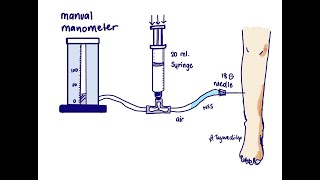 compartment pressure measurement  whitesides technique [upl. by Laehctim]