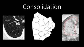 Chest Radiology  Patterns  Airspace [upl. by Latimore]