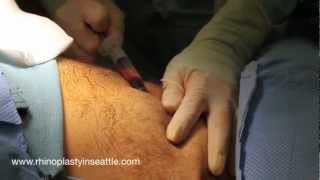 Fat Graft Harvest and Processing  Seattle Facial Fat Grafting [upl. by Heddie]