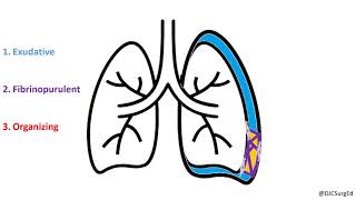 Empyema and Pleural Effusions [upl. by Jacoby]