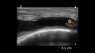 Knee Effusion Ultrasound Image Interpretation [upl. by Isawk48]