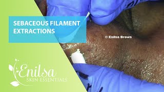 Sebaceous Filament Extractions [upl. by Sibilla925]