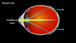 Multifocal Intraocular Lens How Does It Work [upl. by Yerfej327]