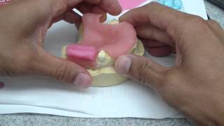 Immediate DentureRPD Jaw Relationship Record Fabrication [upl. by Rediah]