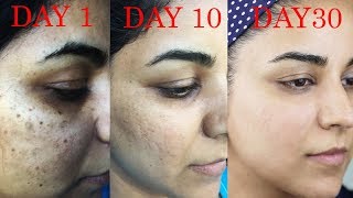 How I Got Rid of Dark Scars Hyperpigmentation PimplesAcne [upl. by Moonier957]