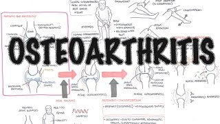 Osteoarthritis Overview causes pathophysiology investigations treatment [upl. by Hambley]