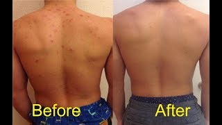 how to get rid of acne on chest and back [upl. by Elleynod]