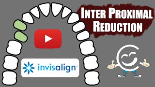 Inter Proximal Reduction IPR For Invisalign Treatments [upl. by Akelahs]