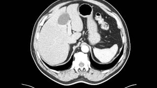 Esophageal leiomyoma distal esophagus  CT [upl. by Kristianson]