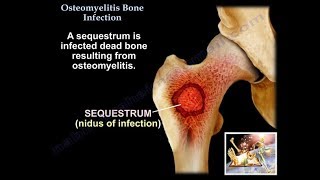 Osteomyelitis Bone Infection  Everything You Need To Know  Dr Nabil Ebraheim [upl. by Julis965]