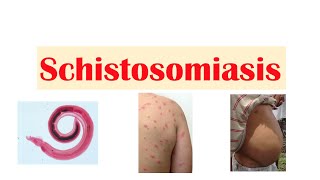 Schistosomiasis  Bilharziasis  Causes Symptoms and Treatment [upl. by Elmaleh]