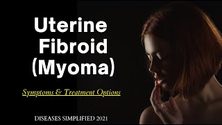 Fibroid Myoma Symptoms amp Treatment Options [upl. by Maharg]