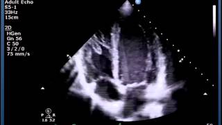 Mastering important TEE views transesophageal echocardiography [upl. by Irt]