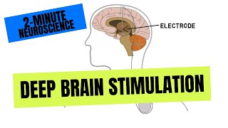 Percutaneous Nerve Testing in Office Step 1 [upl. by Gord]