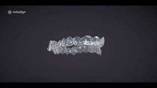 Invisalign Treatment With Mandibular Advancement [upl. by Llerroj]