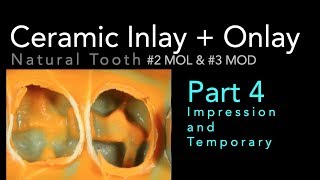 Lithium Disilicate Ceramics Part 4 Impression and Temporary [upl. by Shannah]