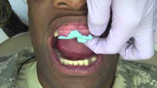 Jaw Relationship Record  Immediate Denture Preparation [upl. by Aicatsan]