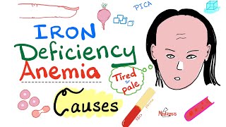 Iron Deficiency Anemia  Causes  Hematology Series [upl. by Hewart]