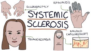 Systemic Sclerosis and Scleroderma Visual Explanation for Students [upl. by Atinal]