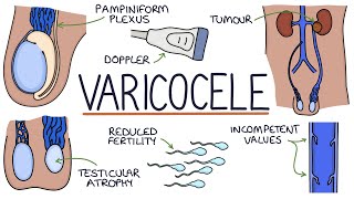 Varicocele Surgery What to Expect [upl. by Graham]