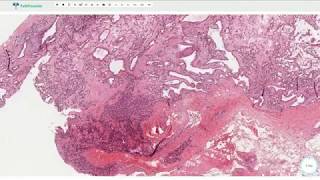 Papillary Endothelial Hyperplasia Masson Tumor  Histopathology [upl. by Gierc]